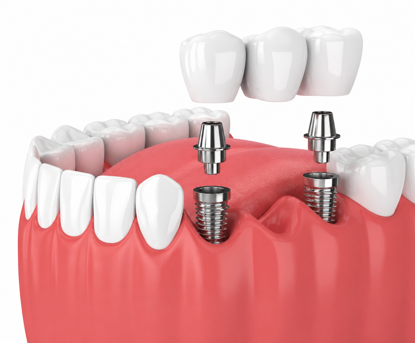 Dental Implants